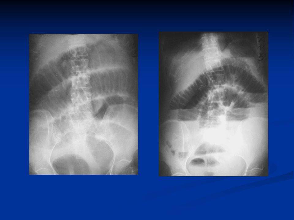 高清图片文字讲解肠梗阻的分类及影像学表现