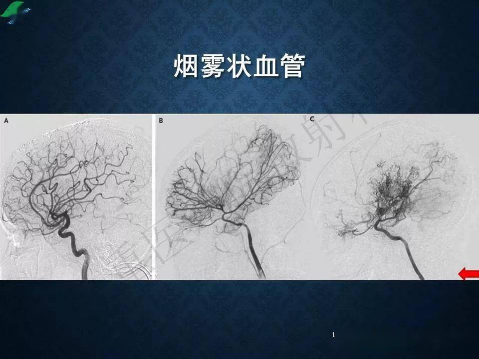 烟雾病的影像学诊断