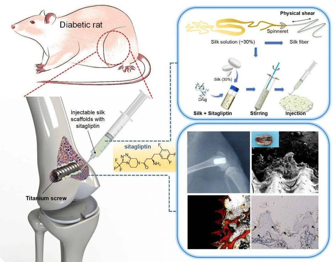 as:可注射蚕丝蛋白载药支架有效促进糖尿病条件下的骨