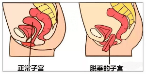 产后如何预防子宫脱垂?微创手术为你解决困扰!