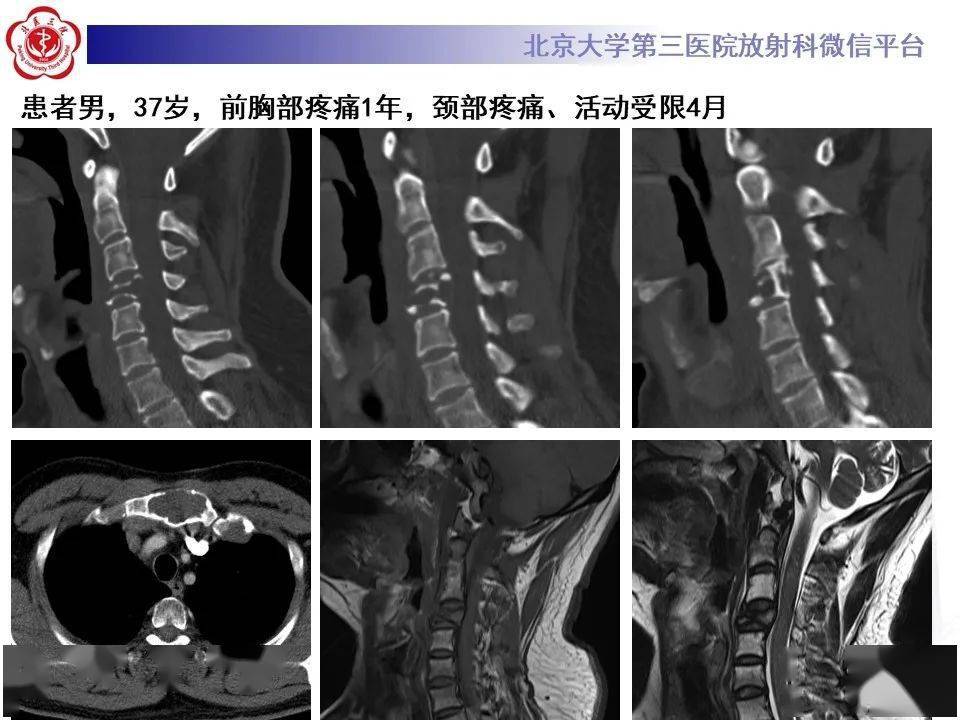 【每日一例1226】女性,67岁症状:右胸部疼痛2月余,逐渐加重