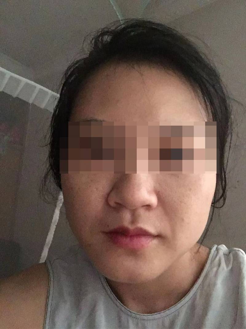 深圳女子拉皮术后留下多条明显疤痕,该机构多次被行政