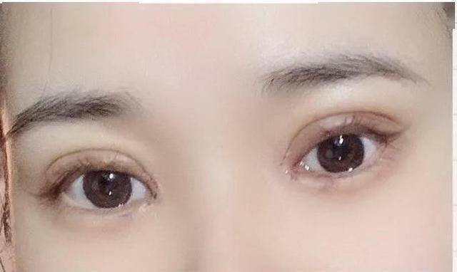 萧山一姑娘花一万多割双眼皮,晒前后对比照,引网友热议