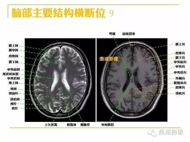 值得收藏高清头颅mr解剖图谱