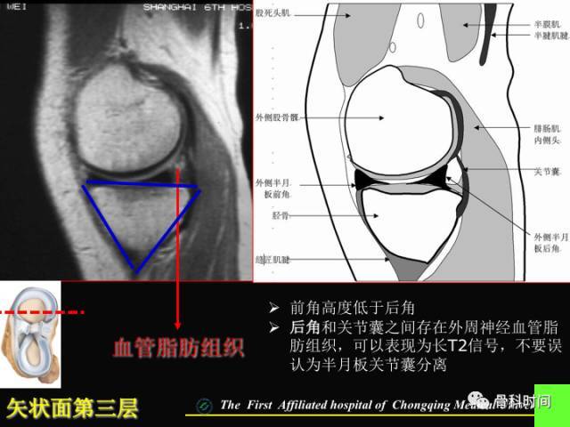 膝关节半月板 mri 入门,看这篇就够了!_平台