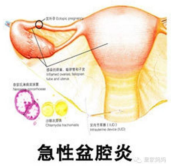 盆腔炎最简单的自愈方法中医