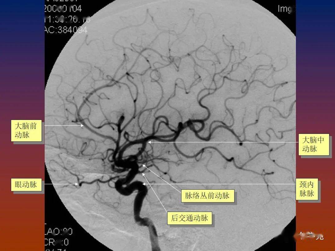 脑血管畸形影像学诊断_动静脉