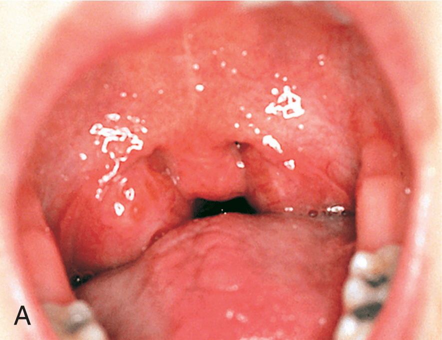 a,弥漫性咽部和扁桃体红肿,多种病原体可导致这种非特异性症状