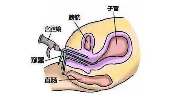 不孕百科之输卵管检查篇