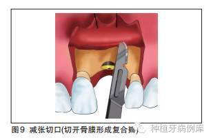 口腔种植手术学图解 组织切开与翻瓣