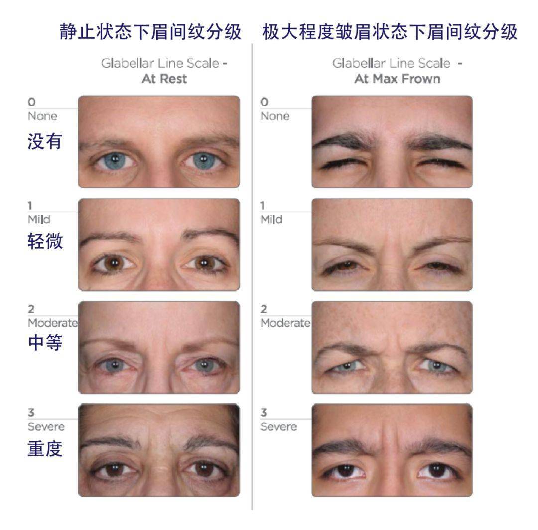 眉间纹注射的最佳深度是多少？皱眉肌三维区域研究解析 - 知乎