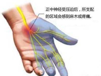 3,感觉:手掌侧拇,示,中及环指桡侧半,手背侧示,中指远节.