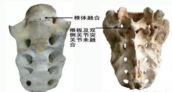 骶骨—常见的解剖变异(图文并茂)