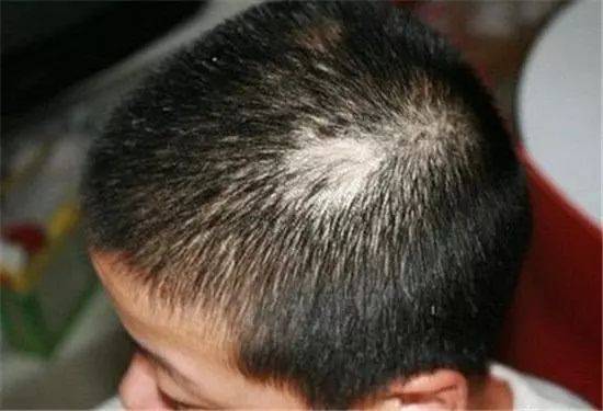斑秃出现的原因