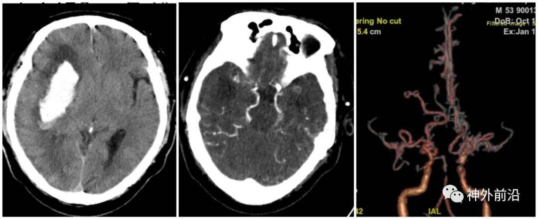 4 m53y-急诊血肿-中动脉显示不清-烟雾病