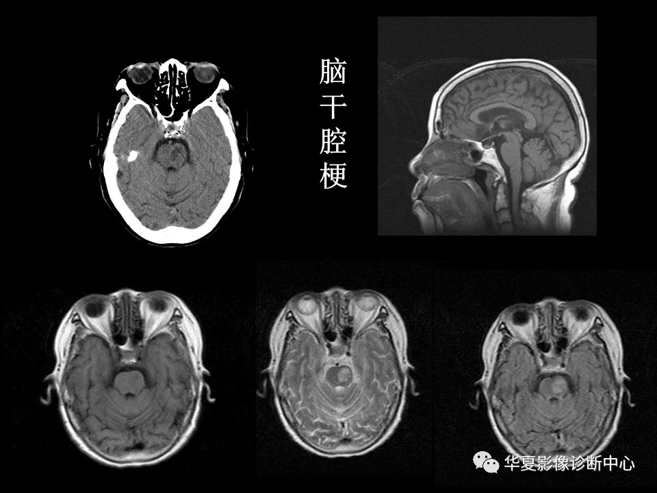 影像复习脑干区常见病变影像表现