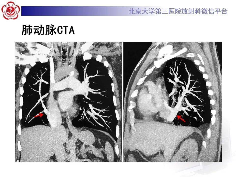 肺静脉异位引流影像学表现