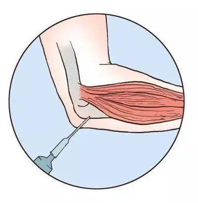 网球肘的症状用什么药 f1a9d932e9ea49b4aa45a7c90bb9e3b5.jpeg