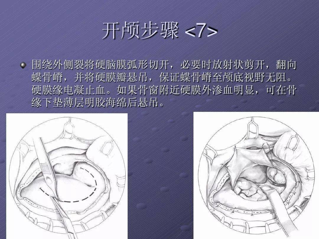 pterion翼点解剖及入路