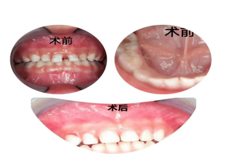 宝宝牙齿有黑点,是牙里有虫吗?
