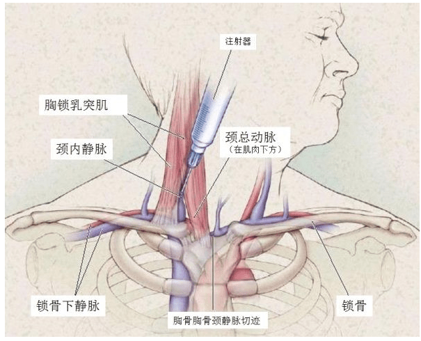 穿刺内衣_骨髓穿刺图片(2)