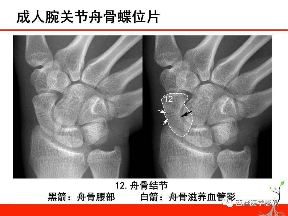 成人腕关节外伤x线诊断