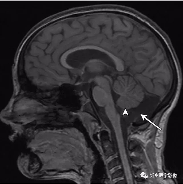 大脑中线处常见的25种疾病_小脑