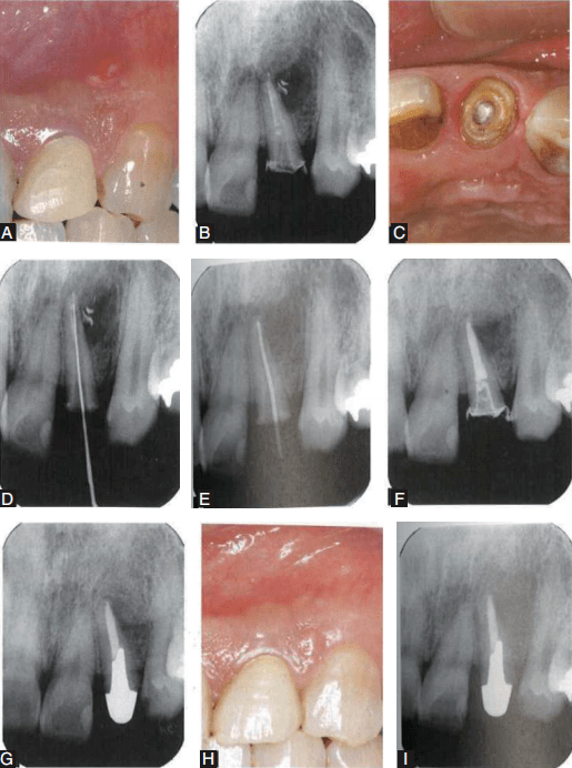 图9 a为术前在患者的牙龈上可见白色的窦道(瘘管)状物;b为术前在根尖