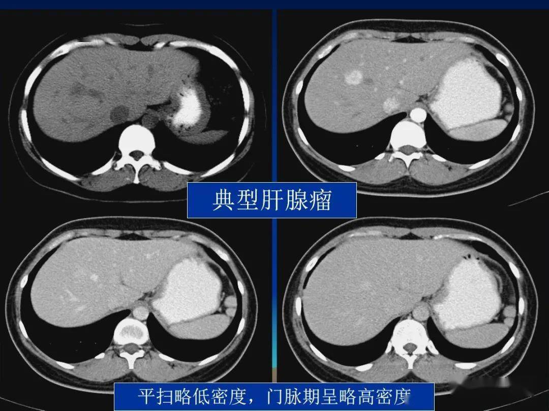 肝细胞腺瘤ha的影像学表现