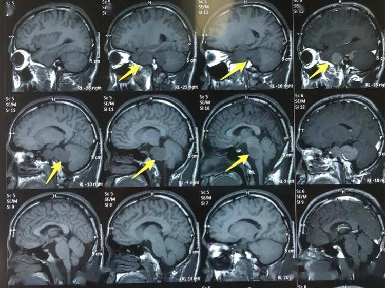 矢状位头颅ct示:鞍旁及桥小脑角区占位