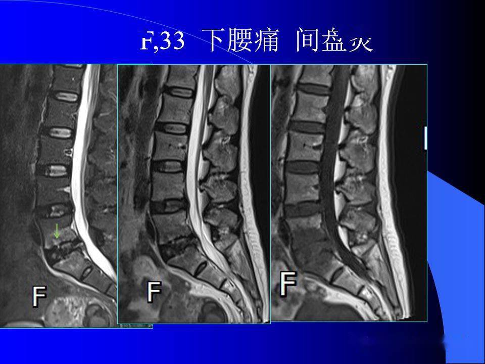 椎间盘发育,退变与病变mri表现