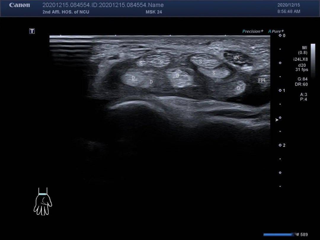 典型超声病例:腕管综合征的超声诊断思路