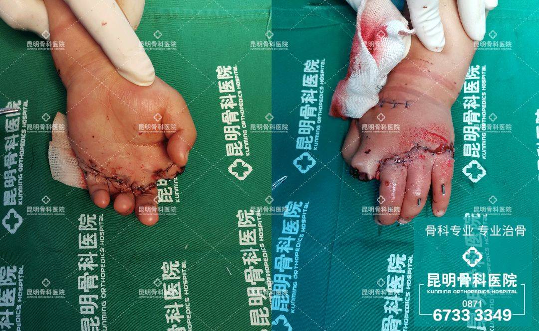 3岁男童4指离断,医生妙手再植成功!_手术