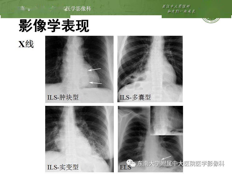 肺隔离症影像表现