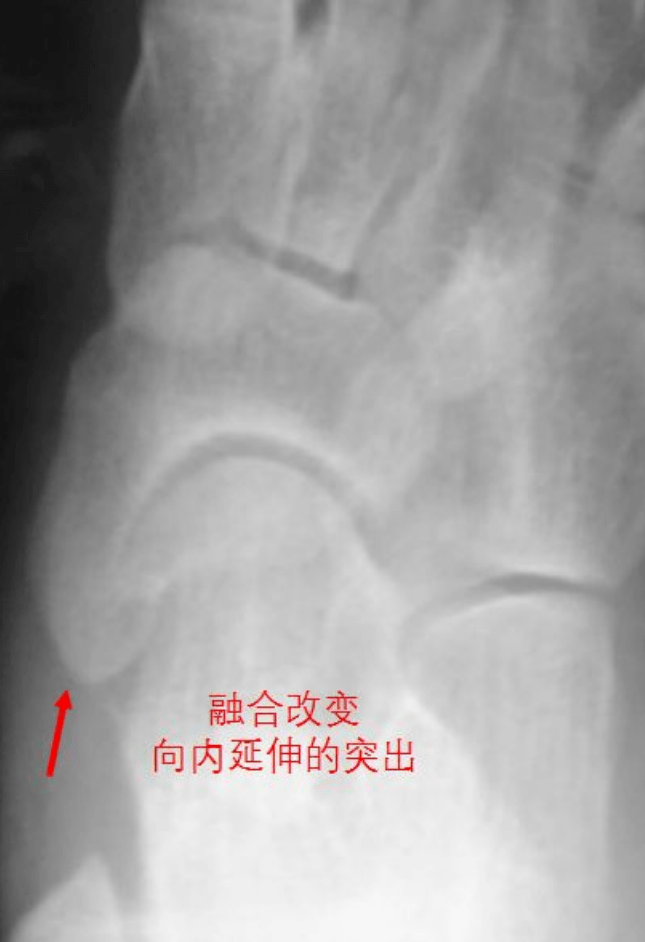 卫生社团足痛隆起畸形当心副舟骨疼痛综合征在作怪