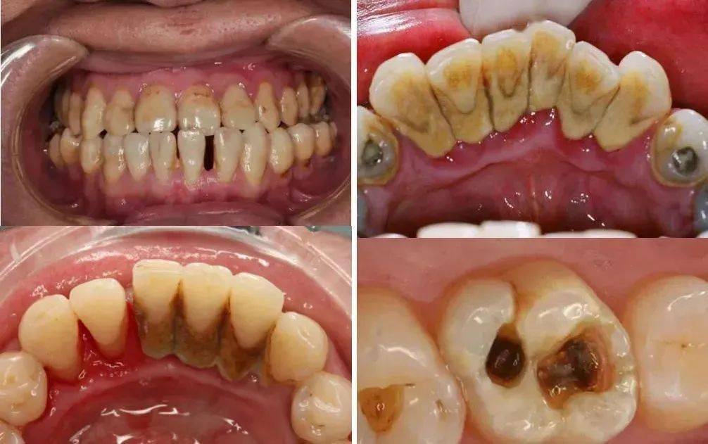 比如牙菌斑,牙周炎, 牙齿有龋洞等