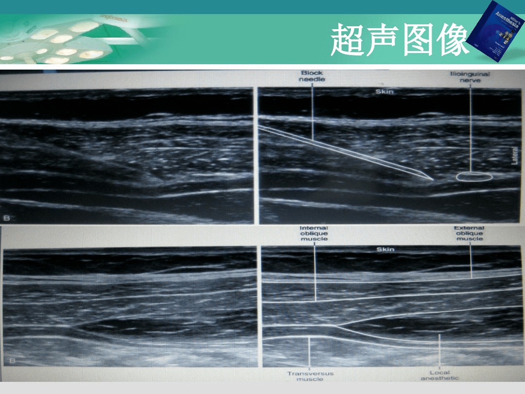 徐医附院麻醉科 | 超声引导下腹横肌平面神经阻滞(tap