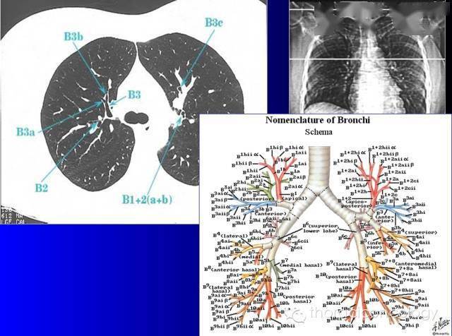 ct支气管解剖