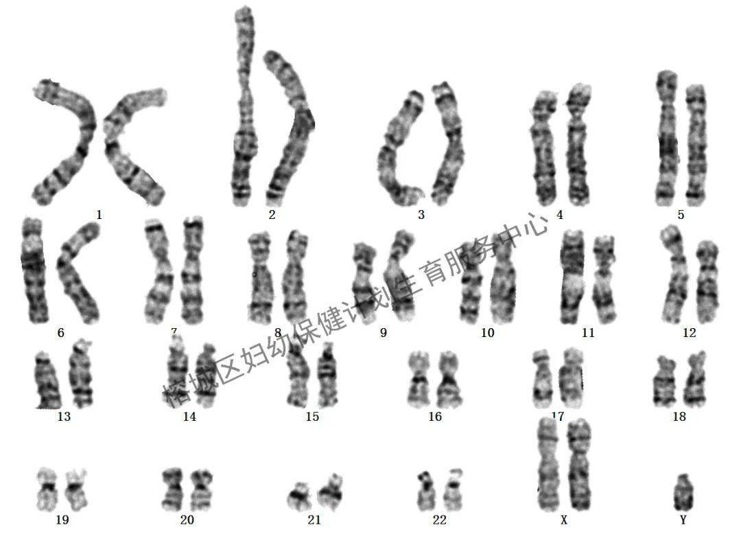 男性中最常见的性染色体异常—克氏综合征