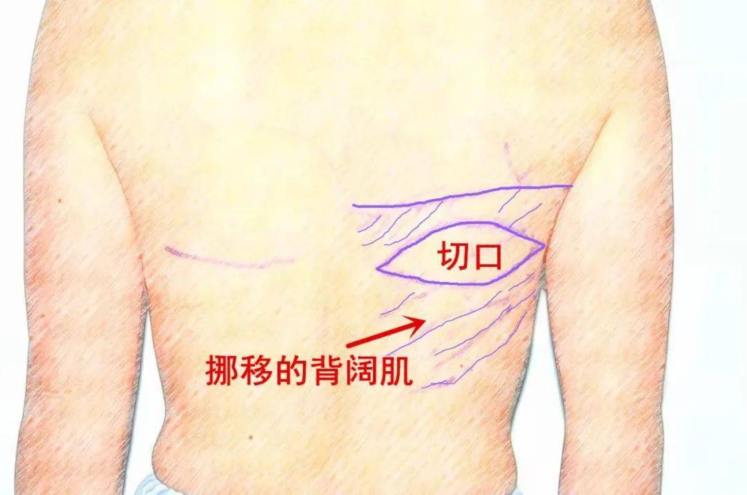 体位调整为左侧卧位 再重新消毒铺巾 在右侧后背取一约10cm的梭行切口