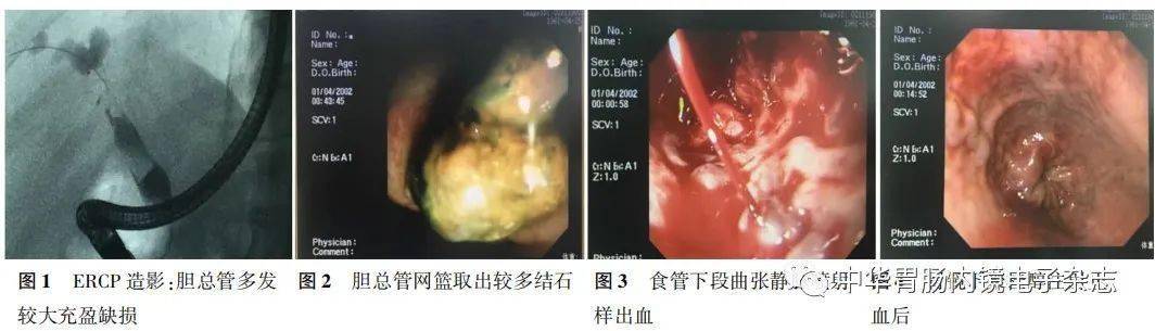 食管胃静脉曲张破裂出血合并急性梗阻性化脓性胆管炎急诊救治成功1例