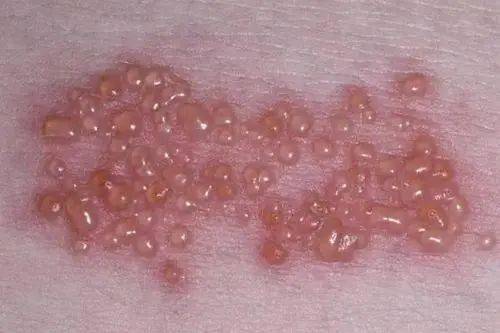 疱疹疾病分类带状疱疹是由水痘-带状疱疹病毒引起的急性感染性皮肤病