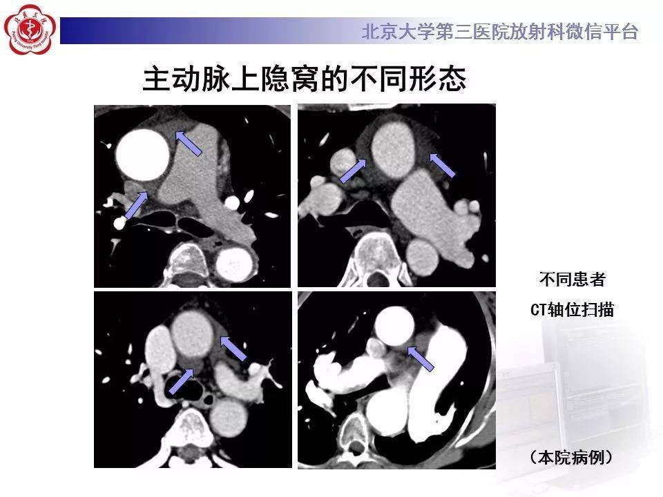 心包窦及心包隐窝解剖