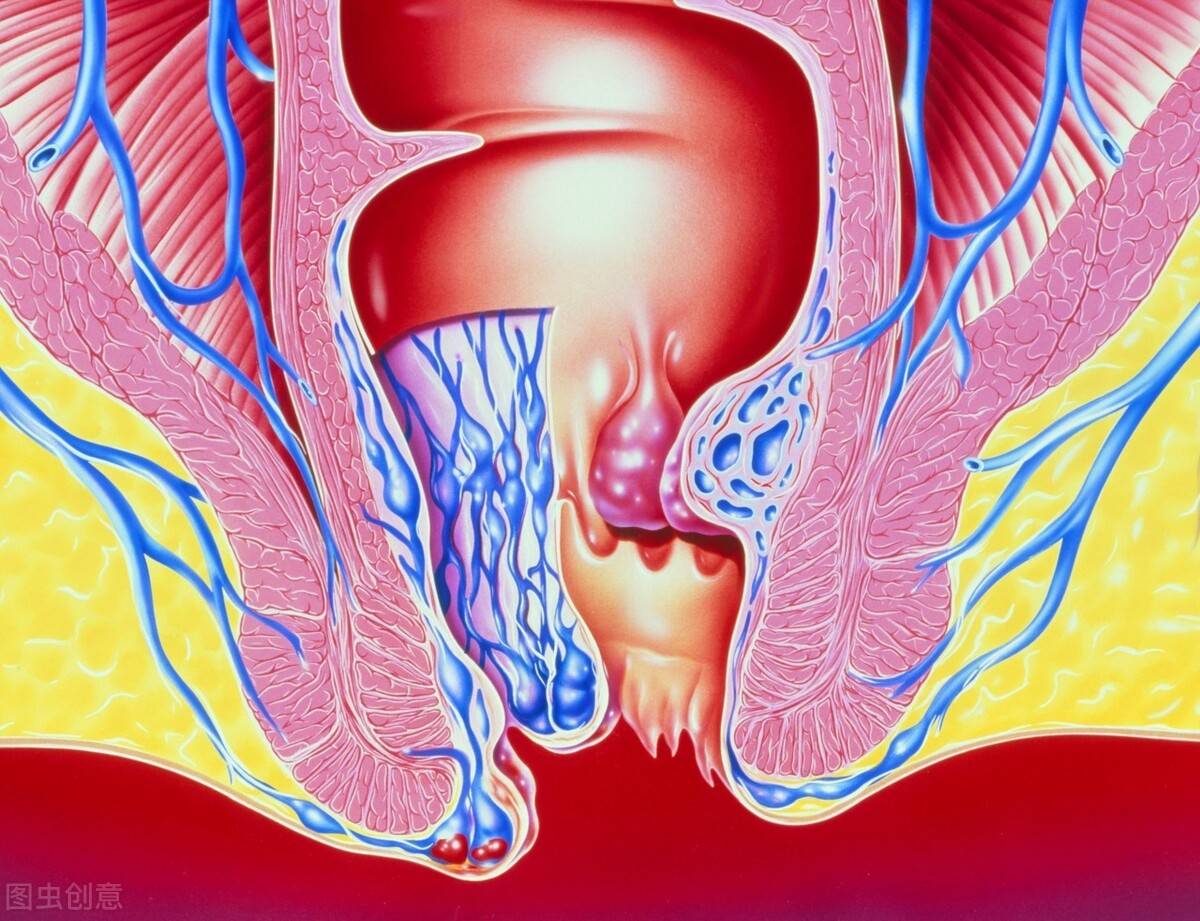 肛门长了个小肉球,是痔疮吗?这2种病也会有肉球凸起,切勿混淆