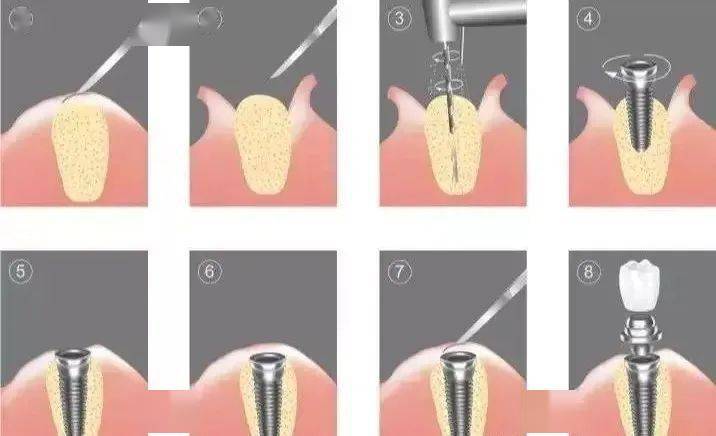 详解种植牙全过程看完都放心种牙了
