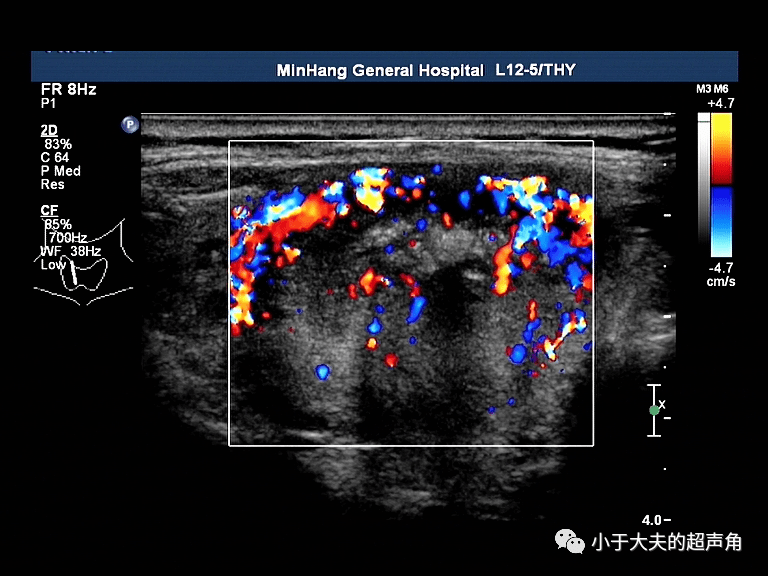 超声随响第51期甲状腺髓样癌