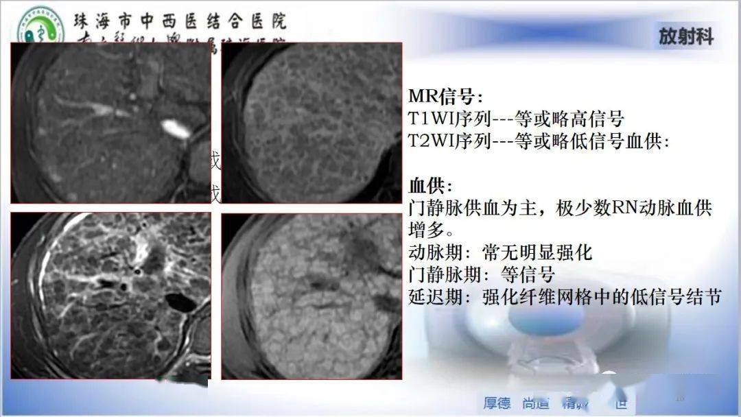 肝脏影像分段及肝硬化结节mri诊断