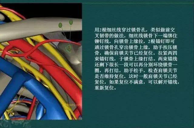 肩锁关节脱位3个步骤9种治疗方法