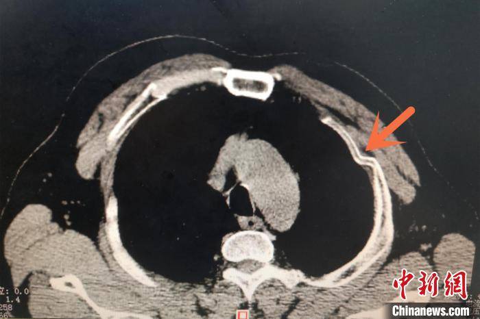 ct显示患者肋骨骨折. 袁志根 摄