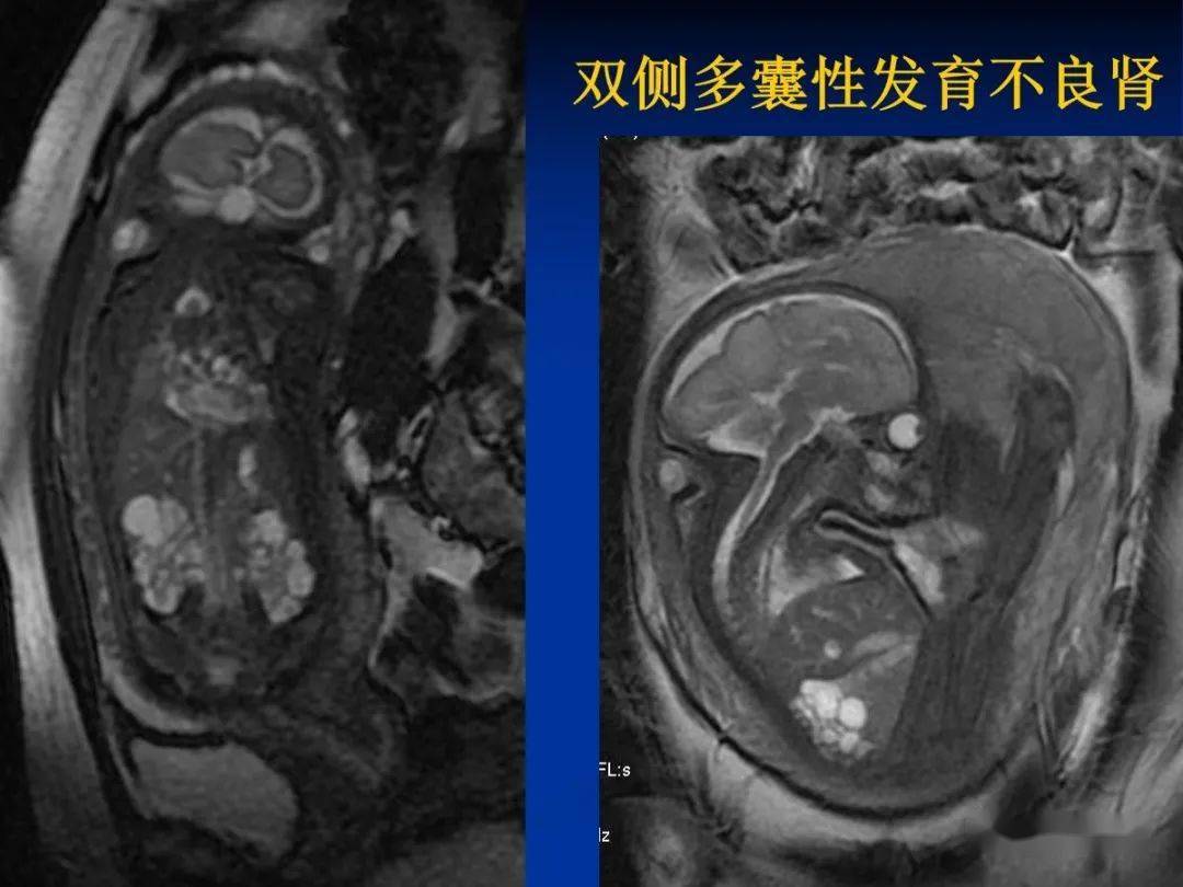 mri在胎儿神经系统畸形诊断中应用